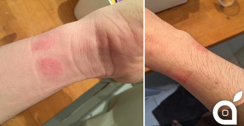 Irritazione dell'Apple Watch