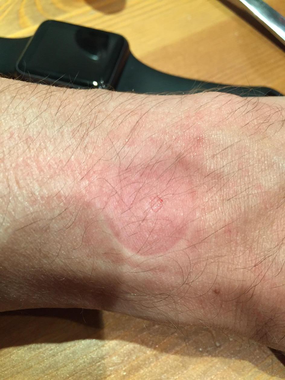 Brûlure de la peau de l'Apple Watch 1