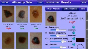 iphone melapp application for detecting cancerous moles