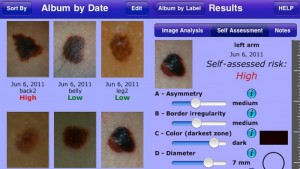 iPhone Melapp-Anwendung zum Erkennen von krebsartigen Muttermalen