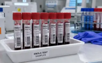 Alertă de EBOLA în Italia la 2 Călători întorși din Uganda, unde OMS a Anunțat Existența unui Focar EBOLA Italia alerta